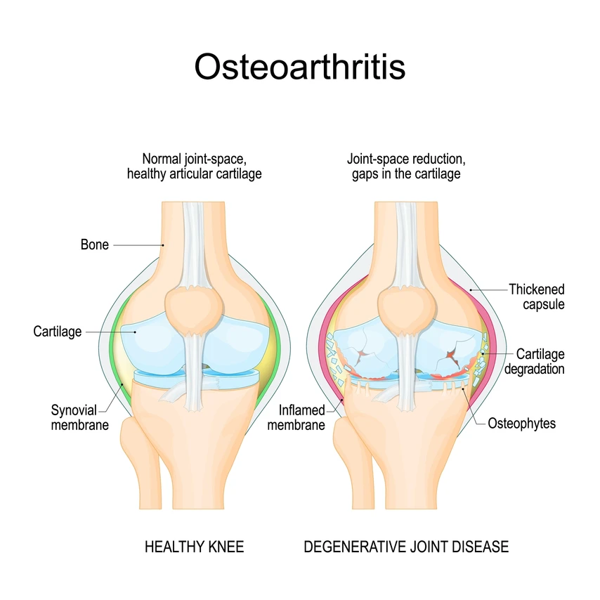 Osteoarthritis in the knee